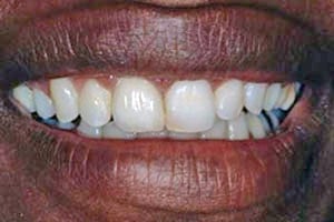 Patient who had needed dental implants and gum enhancement after treatment