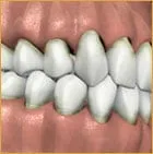 photo represents gum disease in periodontics
